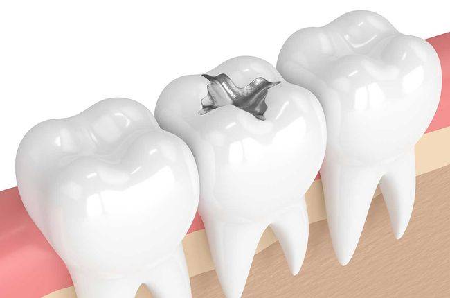 Tooth Fillings service image